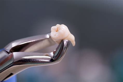Removing Teeth Teeth Extraction Mark Tangri Dental