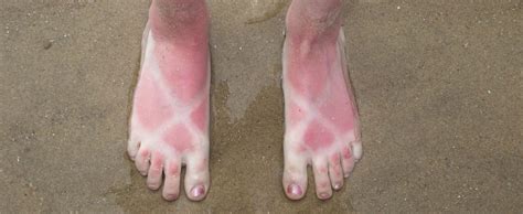 How Treat Sunburn Blisters On Feet Thomas Podiatry And Associates