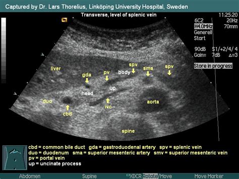 The pancreas is a soft, elongated organ located in the upper abdominal area of the body. Ultrasound of the pancreas: what normal looks like