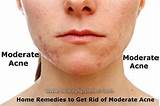 Home Remedies On How To Get Rid Of Acne