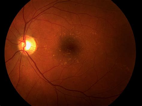 We did not find results for: Macular Degeneration Livingston | Regular Eye Exams ...