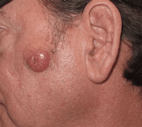 Treatment options for merkel cell carcinoma often depend on whether the cancer has spread beyond the skin. Clinical Photos of Merkel Cell Carcinoma | Merkel Cell Carcinoma