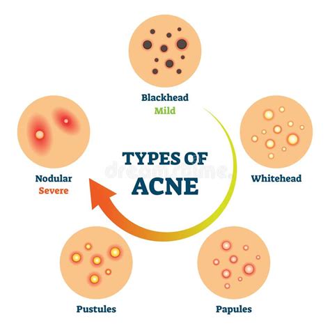 Types Of Acne And Pimples Vector Illustration Stock Vector