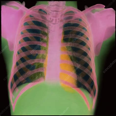 X Ray Of Chest Stock Image P5900140 Science Photo Library