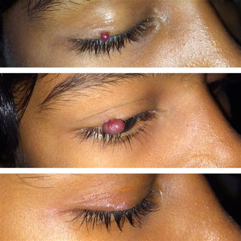 Rapidly Enlarging Acquired Capillary Hemangioma Of The