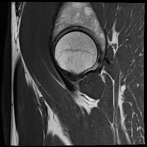 Normal Hip MRI Sagittal View Diagram Quizlet