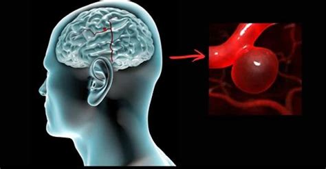 The most reliable test is called a diagnostic cerebral angiogram. Aneurisma cerebral: despeja todas las dudas para saber ...