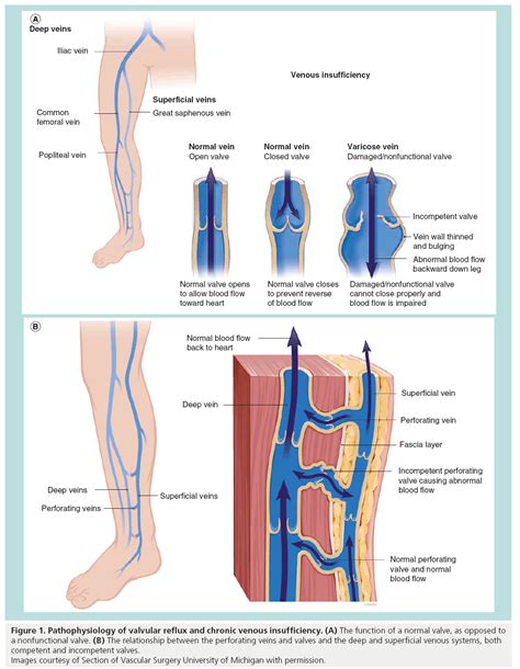 Varicose Veins Evaluating Modern Treatments With Emphasis On Po