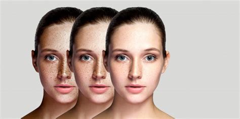 Understanding Melasma Causes Treatment And Prevention • Luciderm