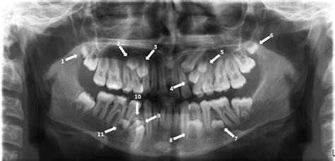 Multiple Bilateral 11 Supernumerary Teeth With Forth Molars In A Non