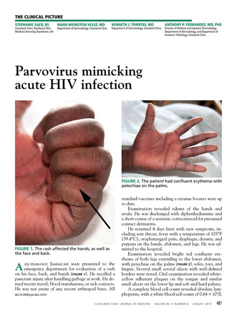 Parvovirus Mimicking Acute Hiv Infection Cleveland Clinic Journal Of