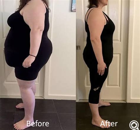 Before Vs After Bariatric Sleeve Gastric Sleeve Sleeve Surgery