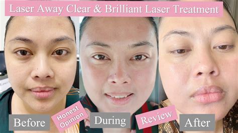 Laseraway Clear And Brilliant Resultshonest Opinion And Review For The