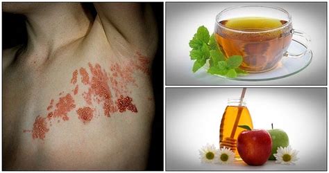 24 Home Remedies For Shingles For Healthy Skin Healthreviewcenter