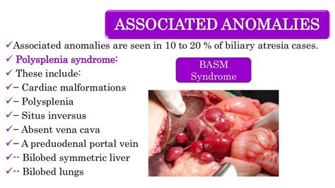 Biliary Atresia Obstructive Jaundice Pediatric Surgery