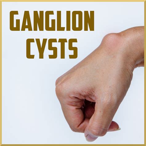 Evaluation Of Ganglion Cysts Sports Activities Medication Evaluation