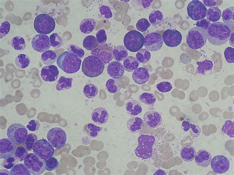 Chronic Myeloid Leukemiachronic Myelogenous Leukemia Cml Stepwards
