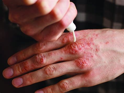 Eczema Tips For Managing Symptoms Royal Examiner