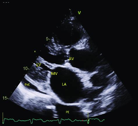 An Echo Image Parasternal Long Axis View From Patient 2 The Left