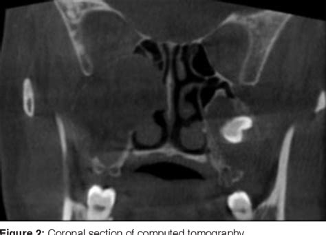 Figure 2 From Bilateral Ectopic Third Molars In Maxillary Sinus