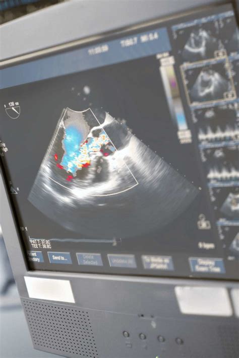 What Is An Echocardiogram Uses Procedure And Results