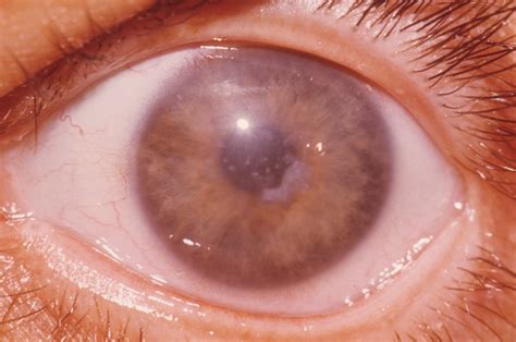3 Diseases Of Cornea And Sclera Diseases Of The Uveal Tract — Tdmuv