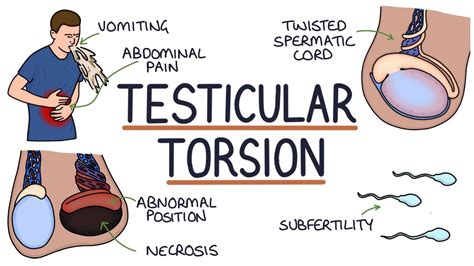Understanding Testicular Torsion Youtube