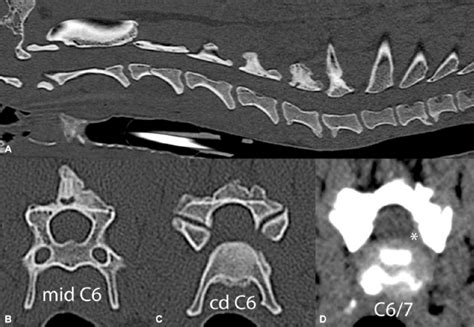 Plain Computed Tomography Study Of The Cervical Spine In Sagittal A