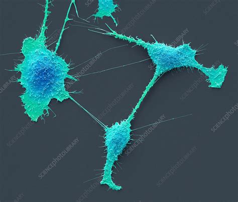 Kidney Cancer Cells Sem Stock Image C0486318 Science Photo Library