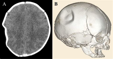 Intrauterine Depression Of The Skull In A Neonate Pediatrics
