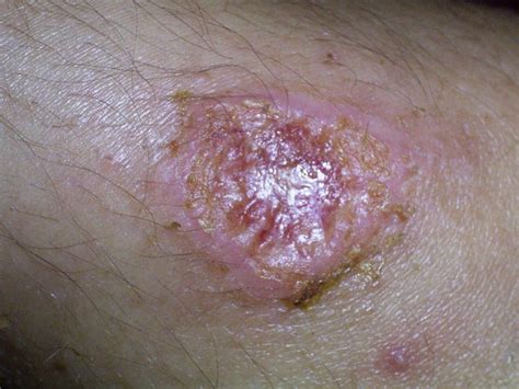 Parasitic Skin Infections Photos Austra Health