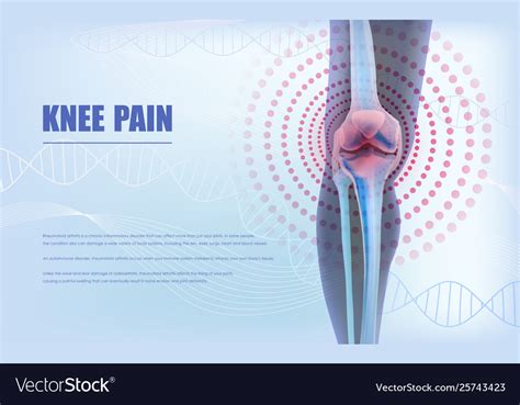 49 Rheumatoid Arthritis Knee Pain Relief Images Propranolols