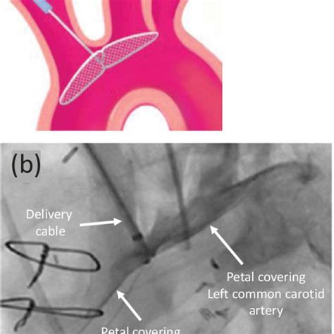 The Embol X Intraaortic Filtration System A Original System