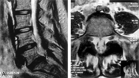 Spontaneous Resolution Of An Intraspinal Synovial Cyst American
