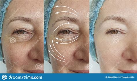 Woman Face Wrinkles Aging Before And After Regeneration Removal