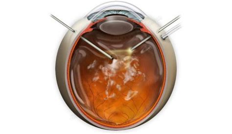 Vitrectomy For Floaters Suvr0020a Stock Eye Images