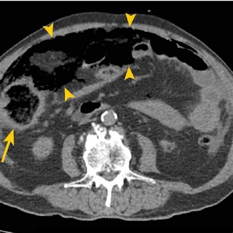Non Contrast Ct Of The Abdomen And Pelvis Of A 75 Year Old Man Who