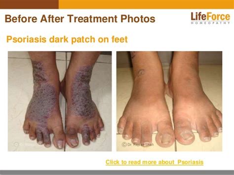 Psoriasis On Legs Photos Before After Treatment Pictures Of Patients