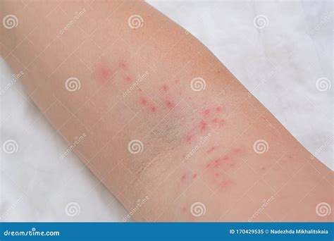 Itchy Bumps On Arms Oultet Website Save 70 Jlcatjgobmx