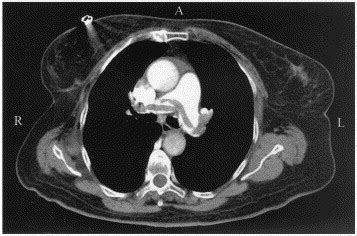 Pulmonary embolism (pe) refers to the occlusion of the pulmonary artery or some of its branches by an embolus. Successful resuscitation of a patient with acute massive ...