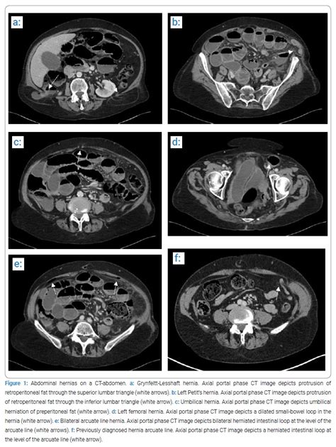 Five Rare Abdominal Wall Hernias In One Patient A Case Report