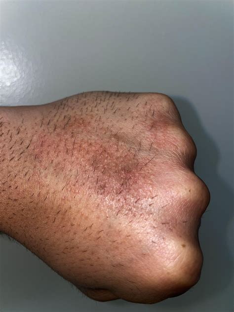 Had This Really Bad Rash On My Both My Hands And It Looks Similar To