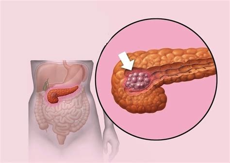 Câncer De Pâncreas Sintomas Inoperável Sobrevivência E Metástase