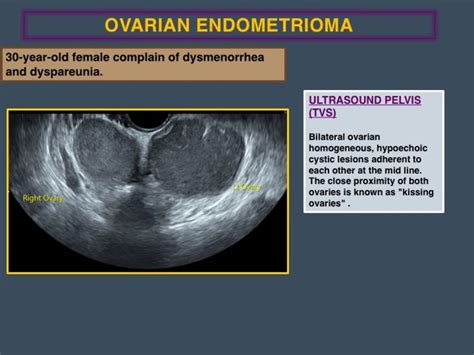 Ovarian Endometrioma Ultrasound Pelvis Download Scientific Diagram