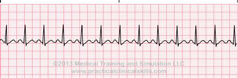 Sinus Tachycardia ECG Interpretation With Sample Strip