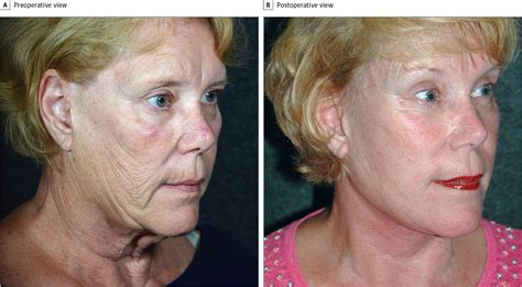 Vertical Sweep Deformity After Face Lift Dermatology Jama Facial