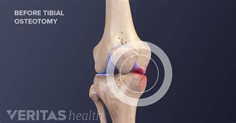 Knee Osteotomy Risks And Complications