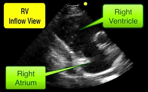 Right Ventricular Inflow Tract View