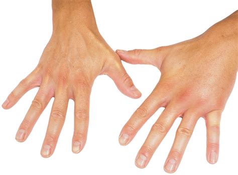 Swollen Hands In The Morning Caused By Arthritis And Other Conditions