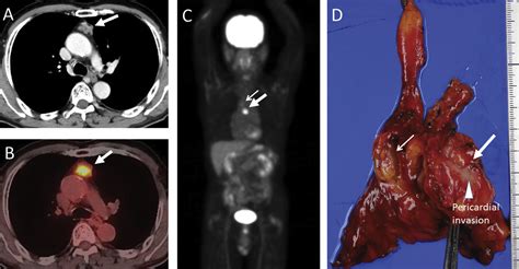 Thymic And Mediastinal Lymph Node Metastasis Of Colon Cancer The